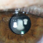 0.2.Lente-Multifocal