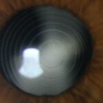 0.5.Lente-Multifocal