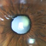 0.6.Lente-Multifocal-1024x845