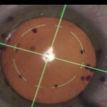 02capsulorhexis