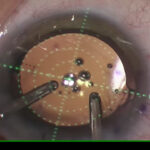 03CENTRAJE-LENTE-MULTIFOCAL