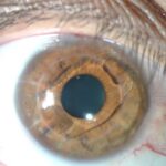 QUERATOPLASTIA-CON-ARTISAN