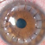 QUERATOPLASTIA-LASER