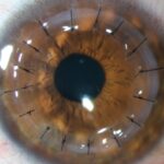 QUERATOPLASTIA-LASER