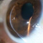 QUERATOCONO-ADELGAZAMIENTO-CORNEA