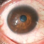 QUERATOCONO-OPACIDAD