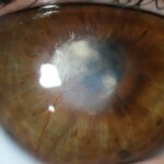 1.Tratamiento Cornea-vascularizada