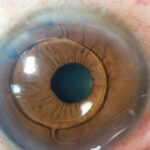 18.LENTE-FAQUICO-DE-CAMARA-ANTERIOR-ARTISAN-1024x813