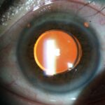 19LENTE-FAQUICO-DE-CAMARA-POSTERIOR-ICL-1024x683