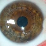3.Tratamiento Transplante-de-cornea