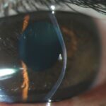 3.cicatriz QUERATOCONO-CON-ADELGAZAMIENTO-APICAL