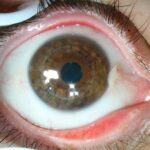 4.Tratamiento -Transplante-de-cornea-con-puntos.