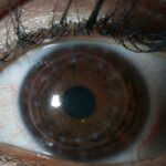 8-QUERATOPLASTIA-LASER