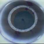 Anillos-queratocono-tunel-0.5