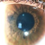 QUERATOCONO-CROSSLINKING-FIBRILLAS