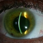 queratocono-crosslinking