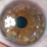 queratocono-queratoplastia