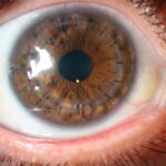 queratocono-queratoplastia-