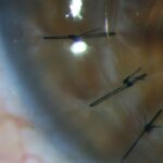 quratocono-queratoplastia